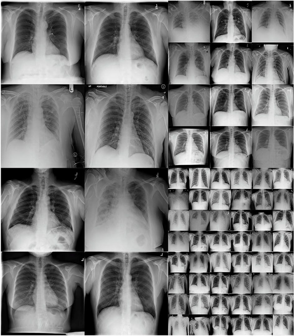 Grid of synthetic chest x-rays