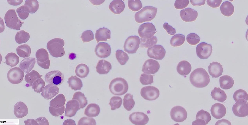Caught in the bloodline: unraveling Thalassemia