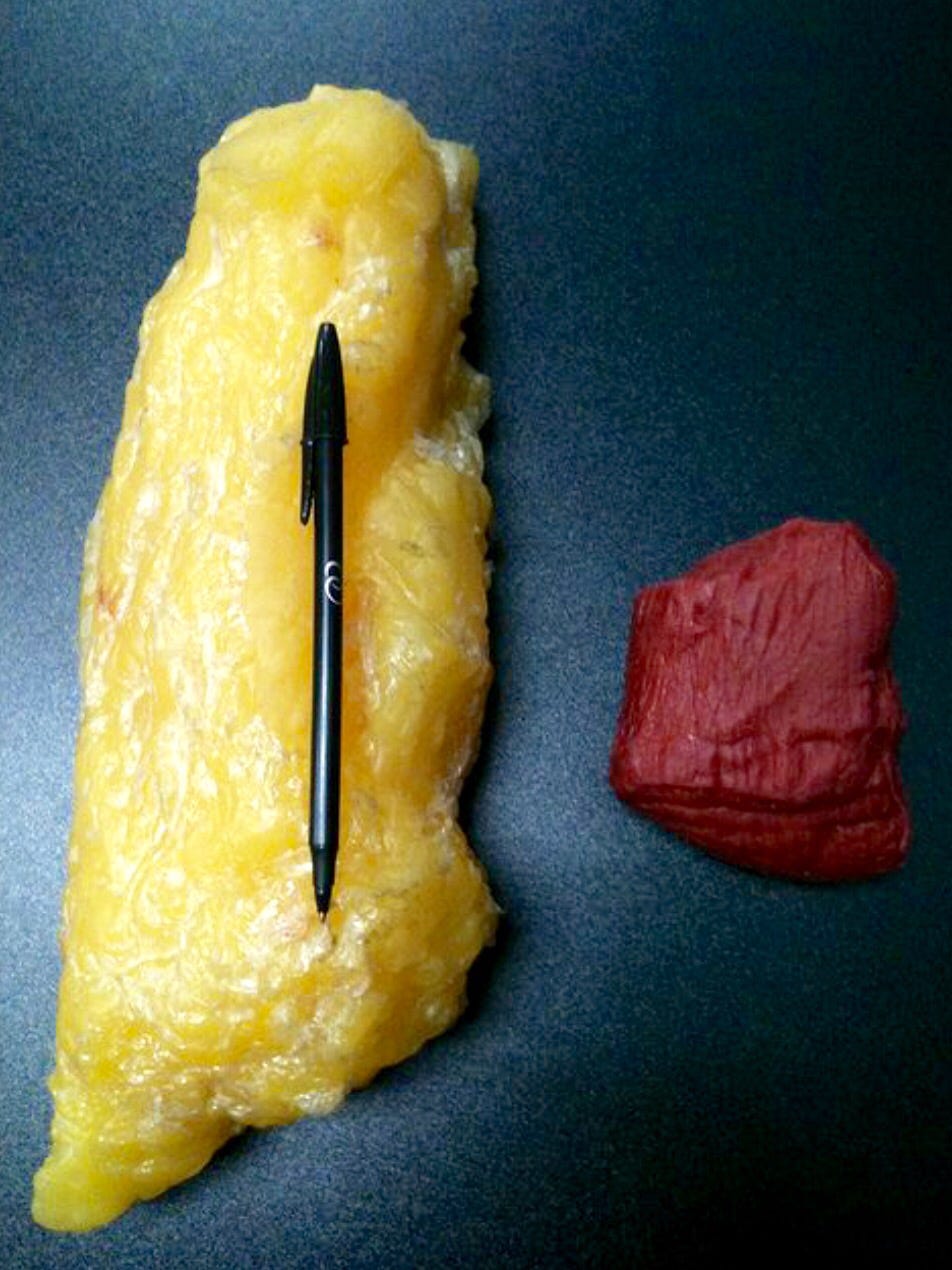 Picture comparing 5 pounds of fat to 5 pounds of muscle