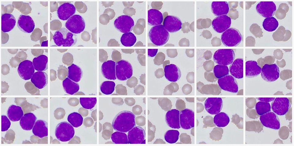 Blasts and their morphological variants — Does morphology matter in the molecular era?