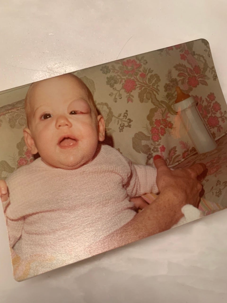 An infant with a swollen and bulging left eye, with 1970’s wallpaper and a bottle in the background. The infant is smiling at her mother, whose hand is visible holding her.