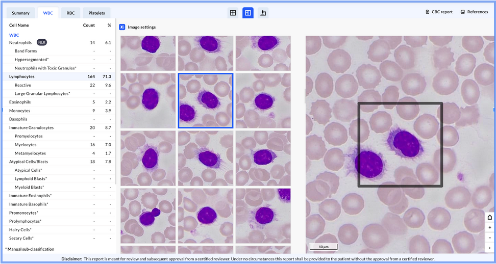 Beyond the hairy cells: Decoding hairy cell leukemia