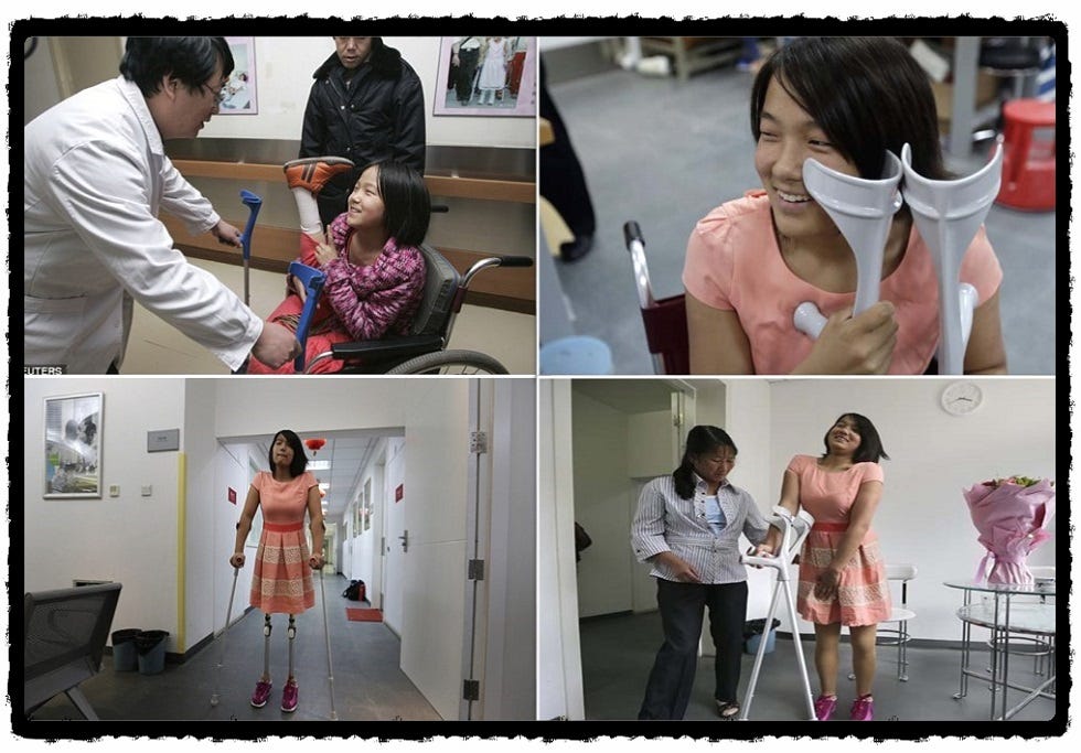 Qian getting acquainted with prosthetics in Beijing Hospital