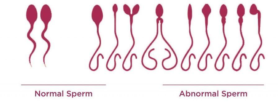 Abnormal sperm shapes
