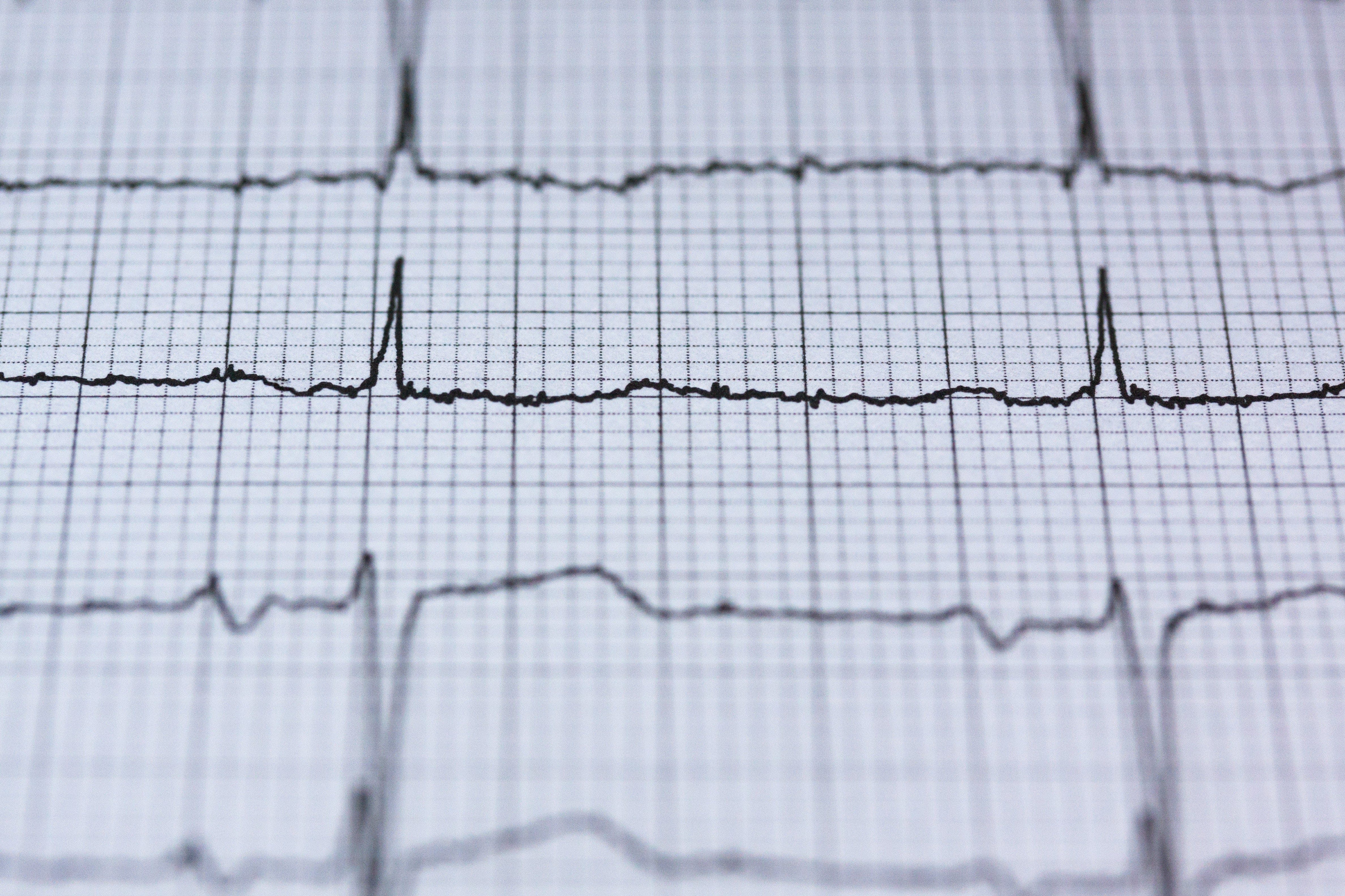 A picture of electrocardiogram, a graph of voltage vs time of the electrical activity of the heart with electrodes