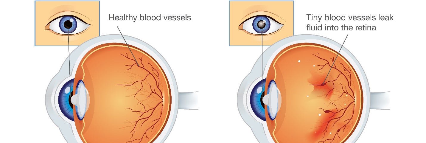 Заболевания и повреждения глаз. Ретинопатия недоношенных глазное дно. Препролиферативная диабетическая ретинопатия глазное дно. Диабетическая ретинопатия поражение сетчатки глаза. Отслоение сетчатки - ретинопатия..
