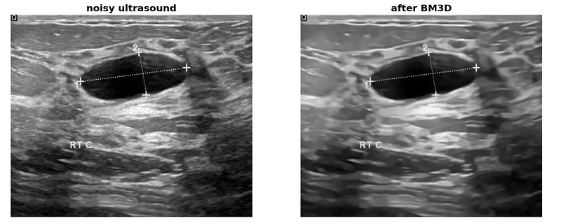 A Stage-by-Stage Breakdown of BM3D for Image Denoising